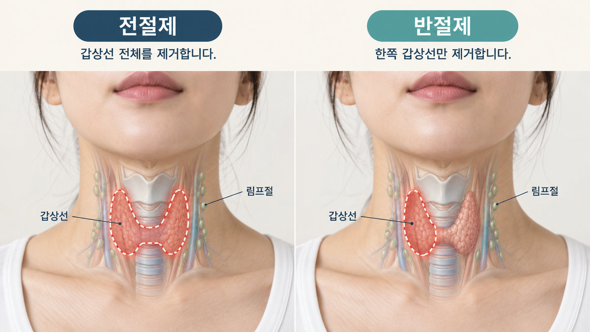 갑상선 전절제와 반절제에서 제거하는 갑상선 좌우 엽과 협부 비교 그림