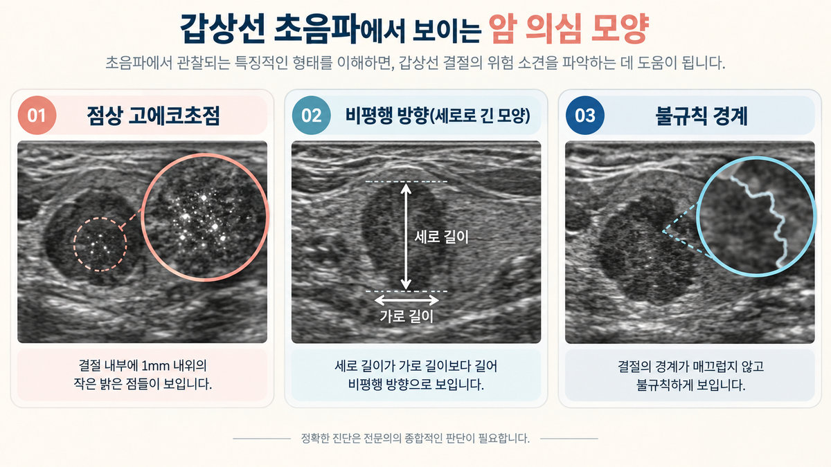 갑상선 초음파 암 의심 모양 점상 고에코초점 비평행 불규칙 경계